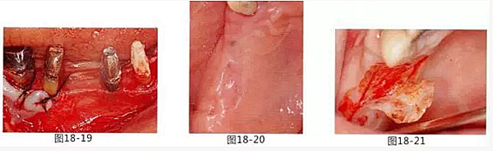 FGG法增大附著齦及根面覆蓋【牙齦-牙槽黏膜的問題】.png FGG法增大附著齦及根面覆蓋【牙齦-牙槽黏膜的問題】.png
