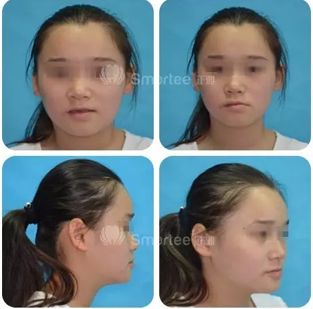 【病例展示】Smartee隱形正畸中國好病例鑒賞第三波反牙合病例 【病例展示】Smartee隱形正畸中國好病例鑒賞第三波反牙合病例