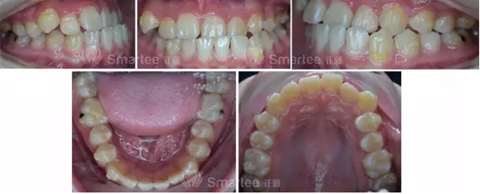 【病例展示】Smartee隱形正畸中國好病例鑒賞第三波 【病例展示】Smartee隱形正畸中國好病例鑒賞第三波