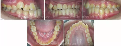 【病例展示】Smartee隱形正畸中國好病例鑒賞第三波 【病例展示】Smartee隱形正畸中國好病例鑒賞第三波