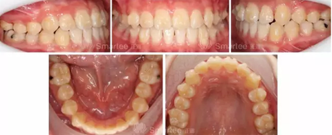 【病例展示】Smartee隱形正畸中國好病例鑒賞第三波 【病例展示】Smartee隱形正畸中國好病例鑒賞第三波