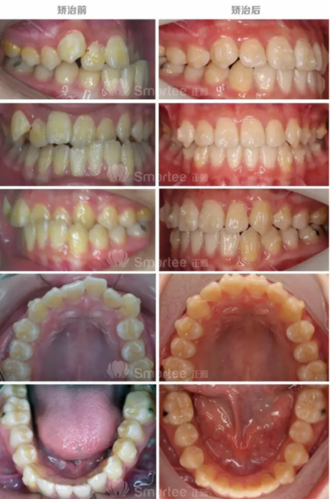 【病例展示】Smartee隱形正畸中國好病例鑒賞第三波 【病例展示】Smartee隱形正畸中國好病例鑒賞第三波