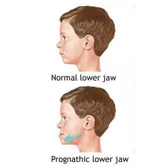 &ldquo;地包天&rdquo;的最佳治療時間