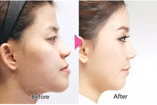 &ldquo;地包天&rdquo;的最佳治療時間