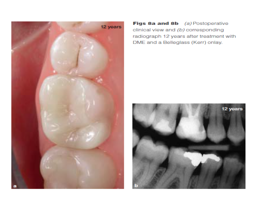 DME: 齦壁提升術(shù) DME: 齦壁提升術(shù)