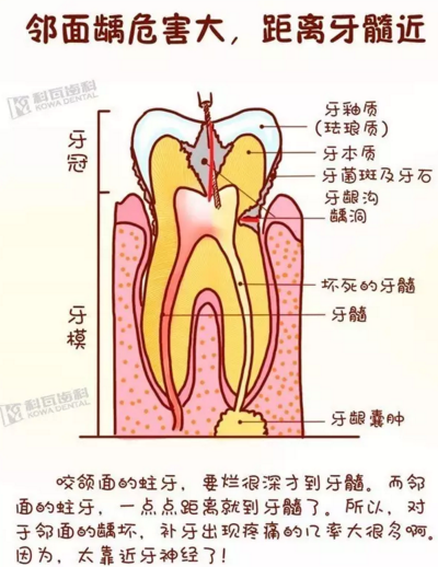 牙縫間的黑線是鄰面齲，還一壞壞倆，巧用它幫你渡過一&ldquo;劫&rdquo;