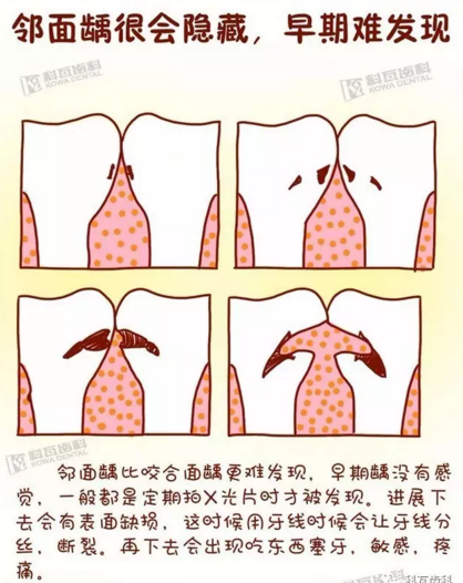 牙縫間的黑線是鄰面齲，還一壞壞倆，巧用它幫你渡過一&ldquo;劫&rdquo;