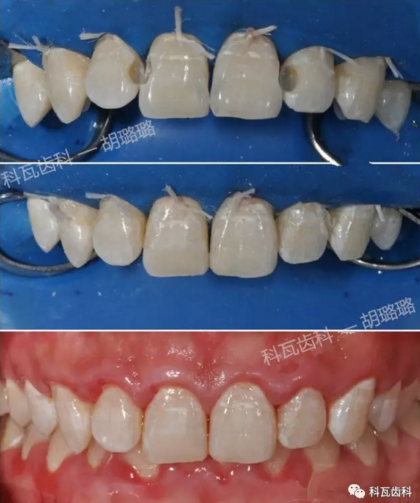 牙縫間的黑線是鄰面齲，還一壞壞倆，巧用它幫你渡過一&ldquo;劫&rdquo;