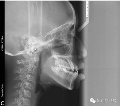 常用X線頭影測量的標(biāo)志點 常用X線頭影測量的標(biāo)志點