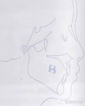 常用X線頭影測量的標(biāo)志點 常用X線頭影測量的標(biāo)志點