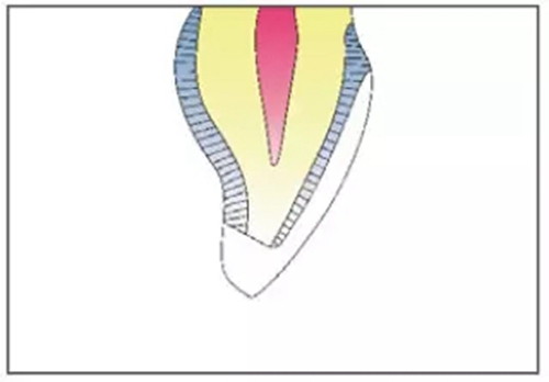 全瓷修復體貼面的制備 全瓷修復體貼面的制備