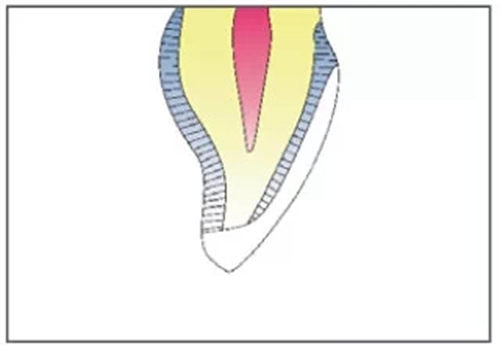 全瓷修復體貼面的制備 全瓷修復體貼面的制備