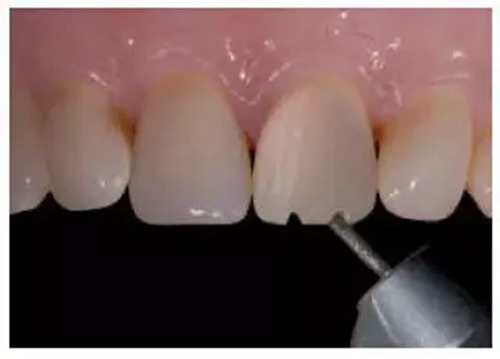 全瓷修復體貼面的制備 全瓷修復體貼面的制備