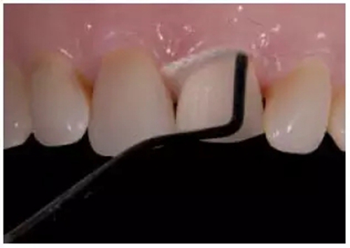 全瓷修復體貼面的制備 全瓷修復體貼面的制備