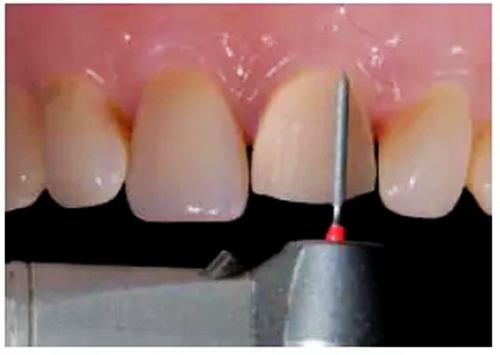 全瓷修復體貼面的制備 全瓷修復體貼面的制備