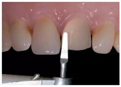 全瓷修復體貼面的制備 全瓷修復體貼面的制備