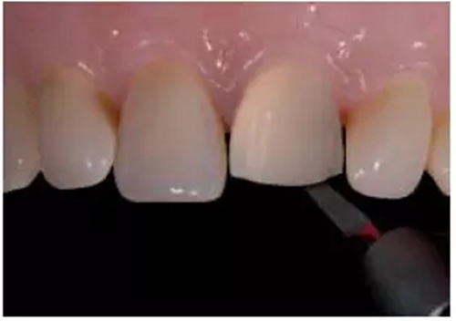 全瓷修復體貼面的制備 全瓷修復體貼面的制備