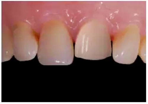 全瓷修復體貼面的制備 全瓷修復體貼面的制備