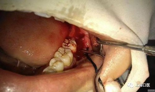 拔牙干槽癥可怕嗎？