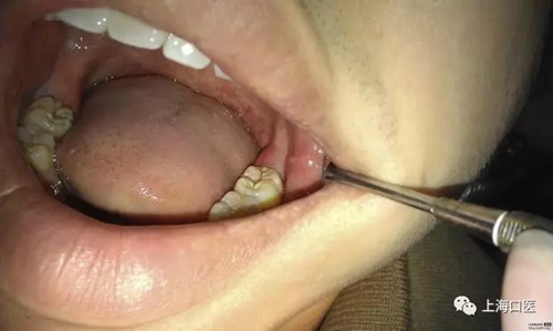 拔牙干槽癥可怕嗎？