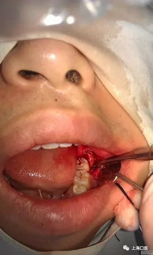 拔牙干槽癥可怕嗎？