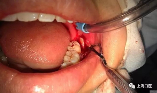 拔牙干槽癥可怕嗎？