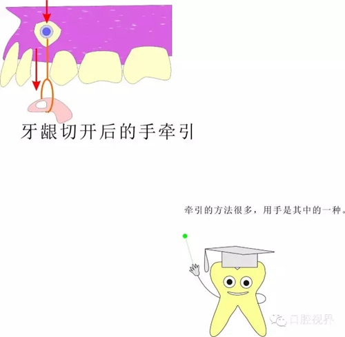 【愛牙科普知識300問】 &ldquo;什么是頜（牙）墊？&rdquo;