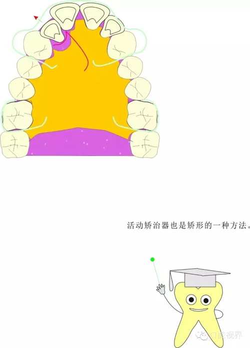 【愛牙科普知識300問】 &ldquo;什么是頜（牙）墊？&rdquo;