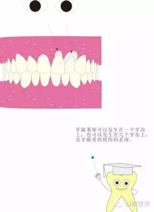 【愛牙科普知識300問】 &ldquo;什么是牙齦萎縮？&rdquo;