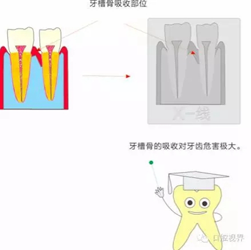 【愛牙科普知識300問】 &ldquo;什么是牙齦萎縮？&rdquo;