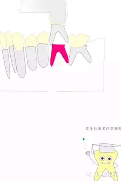 【愛牙科普知識300問】 &ldquo;什么是活髓切斷術？&rdquo;