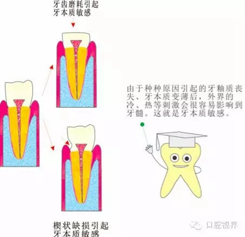 【愛牙科普知識300問】 &ldquo;什么是牙本質(zhì)敏感？&rdquo;