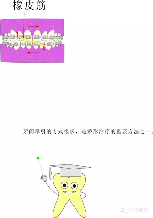 【愛(ài)牙科普知識(shí)300問(wèn)】 &ldquo;什么是牙間牽引？&rdquo;