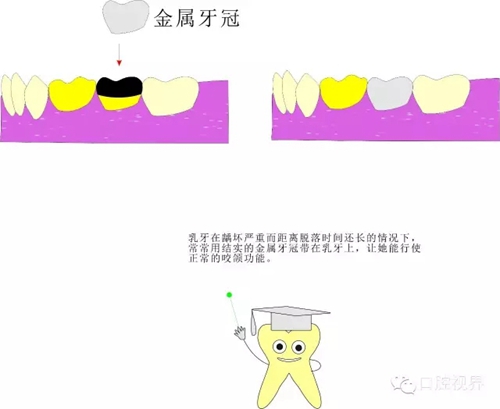 【愛(ài)牙科普知識(shí)300問(wèn)】 &ldquo;什么是牙間牽引？&rdquo;