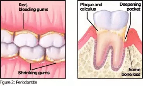 【愛牙科普】口腔謠言終結(jié)者&mdash;&mdash;每天刷牙，洗牙該不該？！