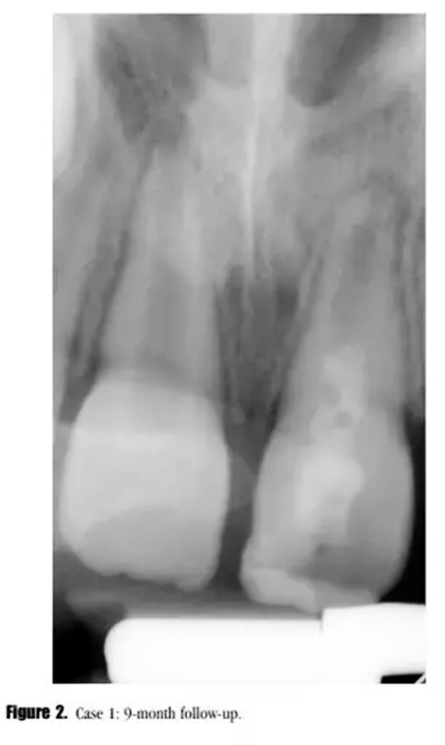 病例分享|牙髓血管再生治療失敗后的牙根發(fā)育:2例 病例分享|牙髓血管再生治療失敗后的牙根發(fā)育:2例