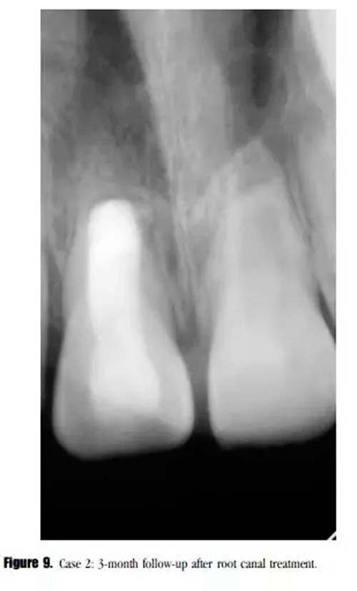 病例分享|牙髓血管再生治療失敗后的牙根發(fā)育:2例 病例分享|牙髓血管再生治療失敗后的牙根發(fā)育:2例