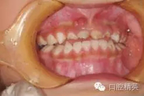 全麻下兒科治療+兒牙樹(shù)脂充填 全麻下兒科治療+兒牙樹(shù)脂充填