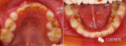 全麻下兒科治療+兒牙樹(shù)脂充填 全麻下兒科治療+兒牙樹(shù)脂充填