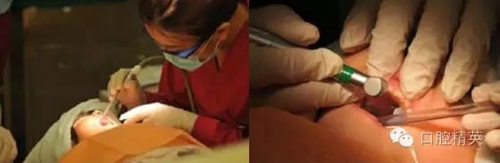 全麻下兒科治療+兒牙樹(shù)脂充填 全麻下兒科治療+兒牙樹(shù)脂充填