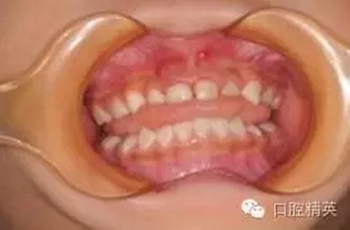 全麻下兒科治療+兒牙樹(shù)脂充填 全麻下兒科治療+兒牙樹(shù)脂充填