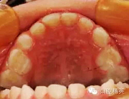 全麻下兒科治療+兒牙樹(shù)脂充填 全麻下兒科治療+兒牙樹(shù)脂充填