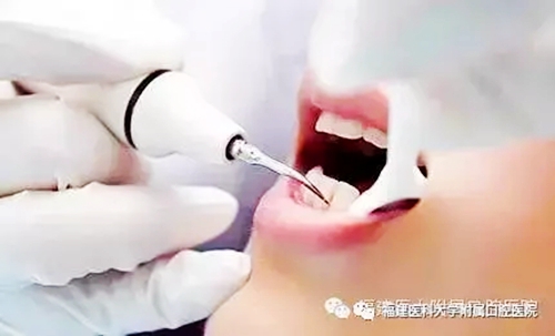 牙結(jié)石是怎么從一個(gè)