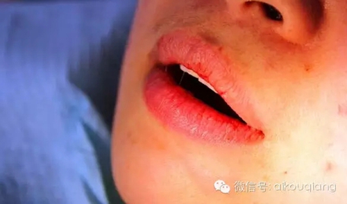 粘液腺囊腫 粘液腺囊腫