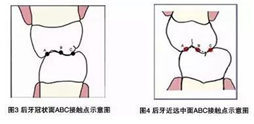 【臻美推薦】現(xiàn)代牙合學(xué)概念與全口固定義齒咬合重建 【臻美推薦】現(xiàn)代牙合學(xué)概念與全口固定義齒咬合重建