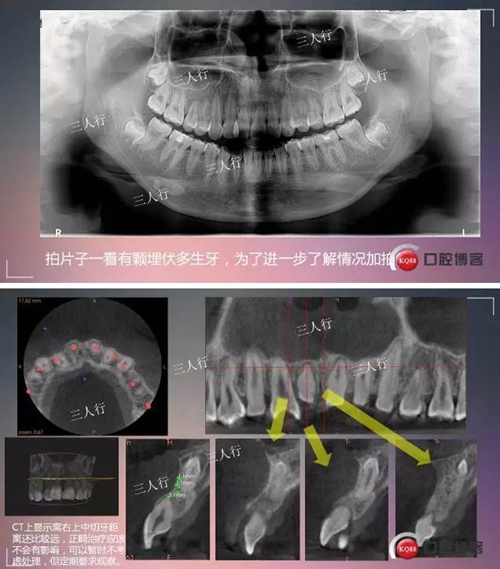 深部埋伏多生牙&mdash;&mdash;微創(chuàng)處理  