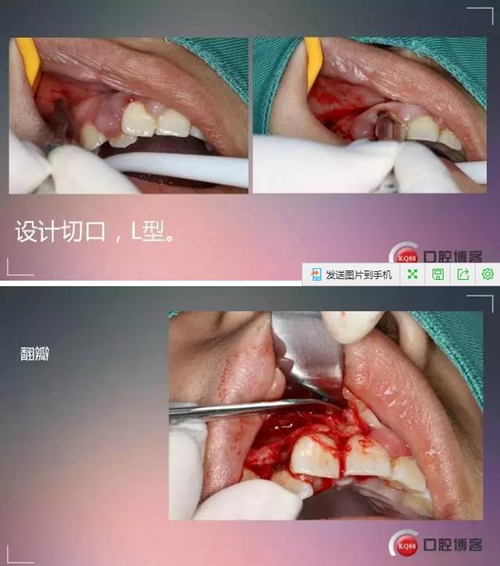 深部埋伏多生牙&mdash;&mdash;微創(chuàng)處理  