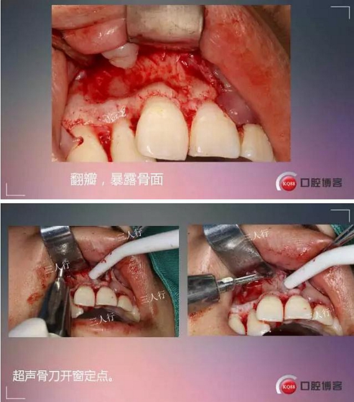 深部埋伏多生牙&mdash;&mdash;微創(chuàng)處理  
