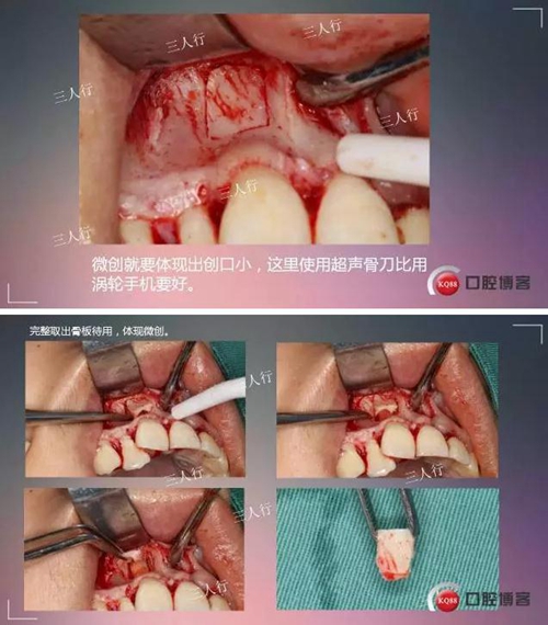 深部埋伏多生牙&mdash;&mdash;微創(chuàng)處理  