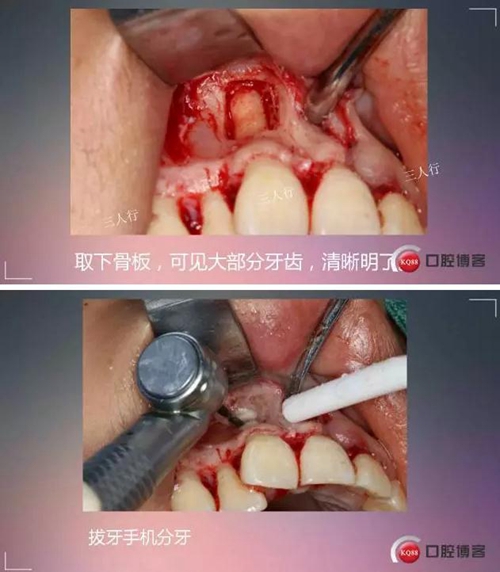 深部埋伏多生牙&mdash;&mdash;微創(chuàng)處理  